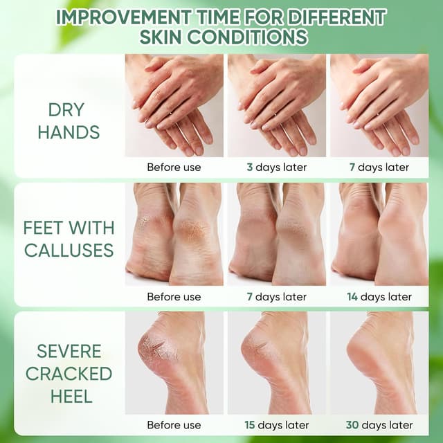 Detalle 2 de Crema Urea 50% per piedi, mani e zone ruvide con acido salicilico 2% (max 150 g) con cocco, acido ialuronico, tea tree e aloe vera