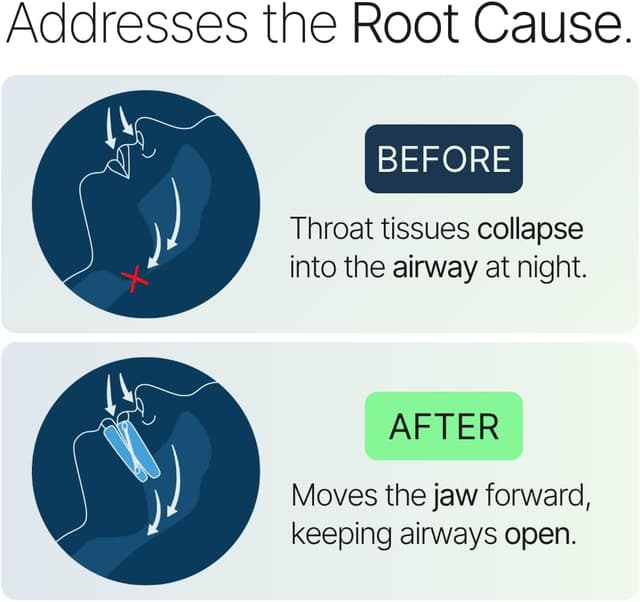Detalle de Somnofit-S Anti-Snore Mouth Guard by SnoreLessNow (Swiss-Made, FDA Cleared) — Adjustable Anti-Snoring Mouthpiece
