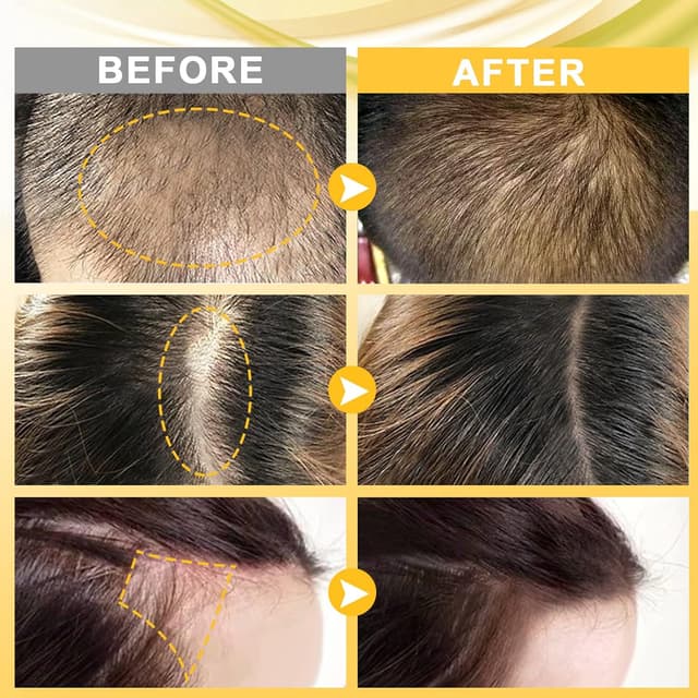 Thumbnail 4 de Beayosses Dermaroller Set 0.5mm Haarwachstum