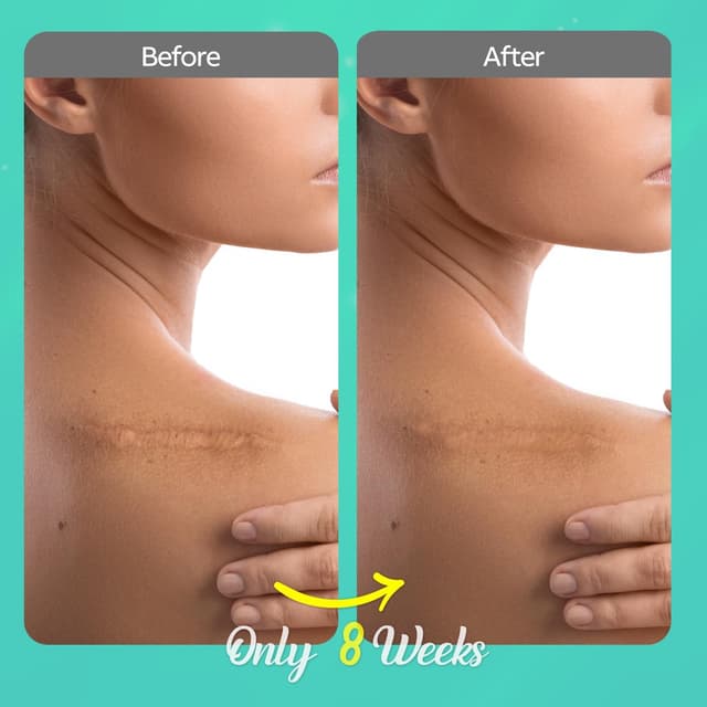 Detalle 2 de Scar Gel Narbencreme – Pflegelösung für frische sowie alte Narben