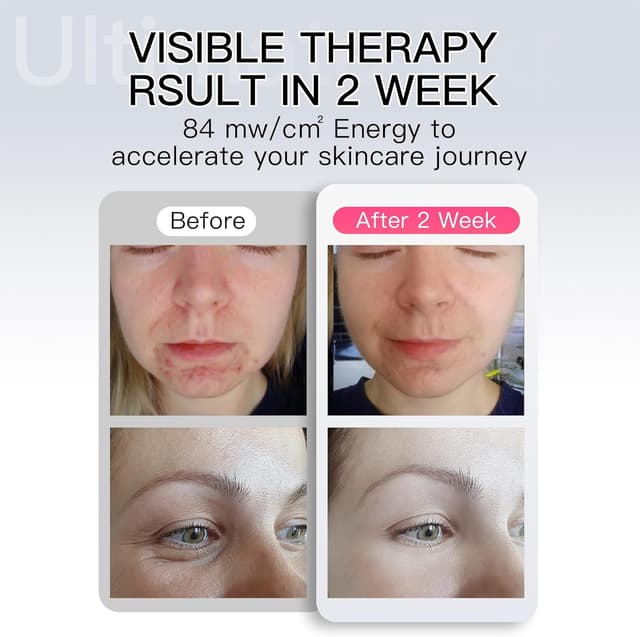 Thumbnail 5 de IBORRIA Máscara LED Facial de Silicona para Rejuvenecimiento ✨