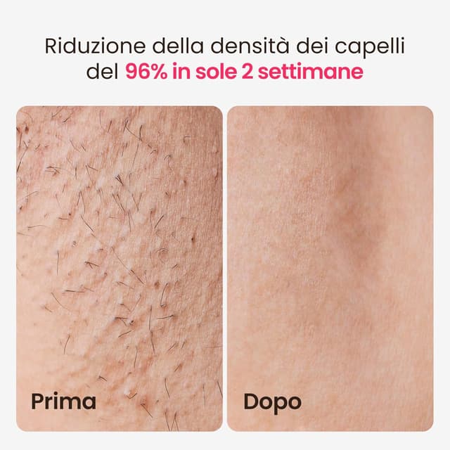 Detalle de Epilatore laser IPL 25J con triplo impulso e zaffiro a 3°C (viola) – per uomo e donna