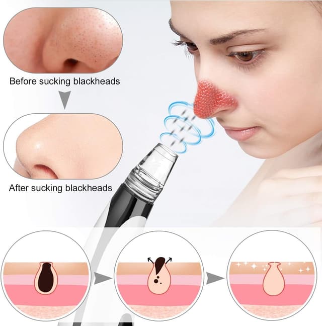 Detalle 2 de Blackhead Remover Vacuum 60Kpa