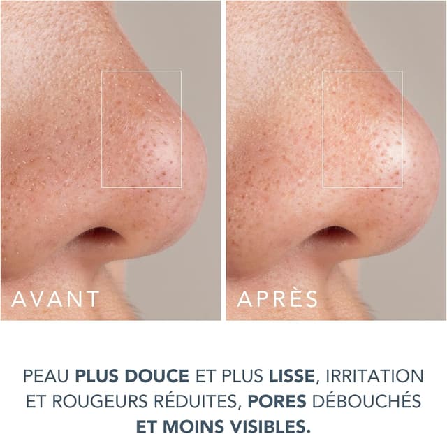 Thumbnail 6 de FOREO Smooth & Resurface KIWI aspirateur points noirs