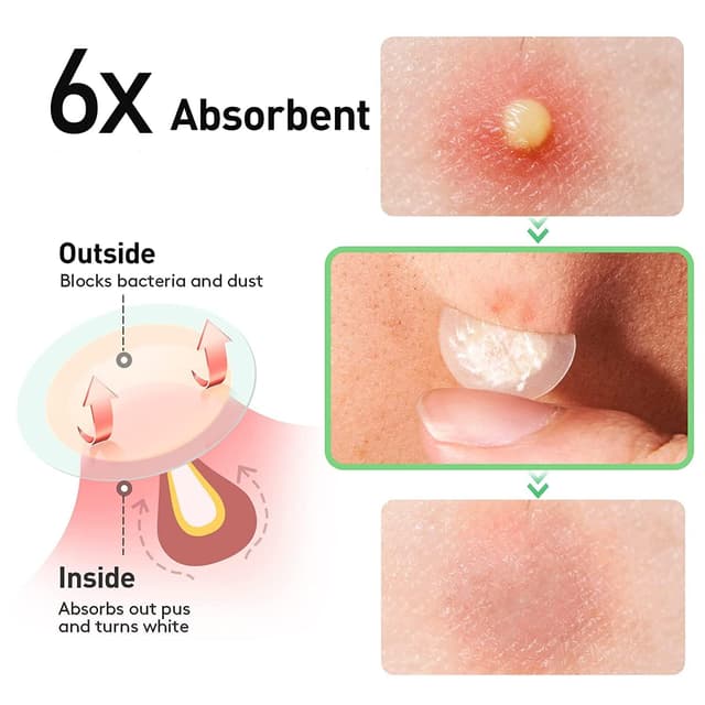 Thumbnail 1 de Zebrlan 300 Stück Pimple Patches 300 Stück