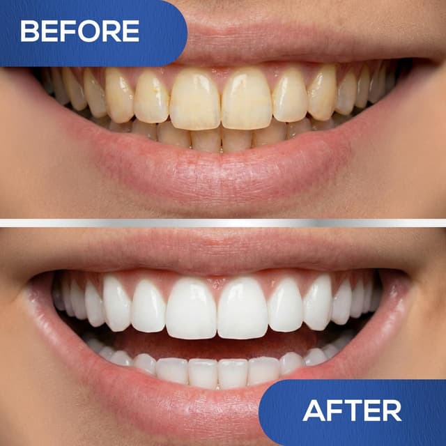 Detalle 2 de Venus Visage LED Teeth Whitening Kit 35% Gel