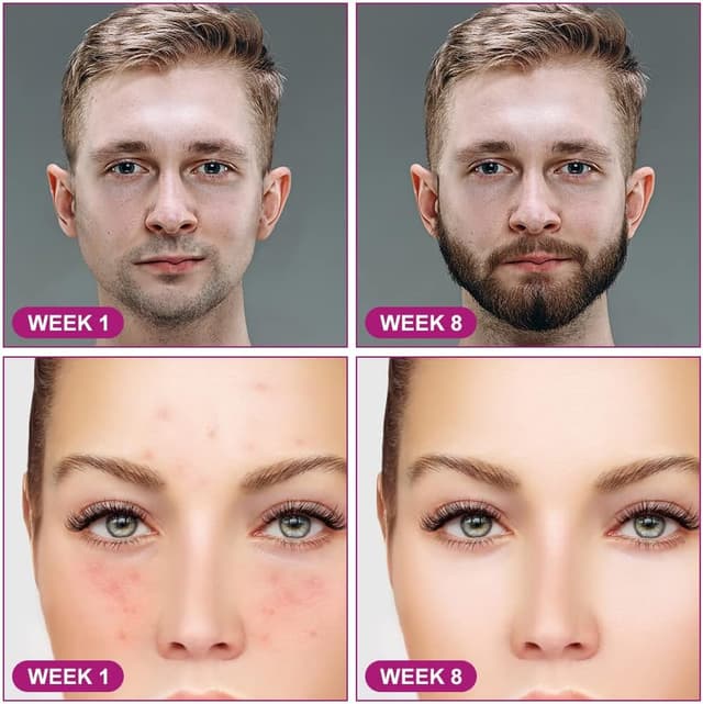 Thumbnail 6 de LOPHE Derma Roller 0,5 mm – Dermaroller visage à micro-aiguilles pour anti-rides, anti-âge et marques