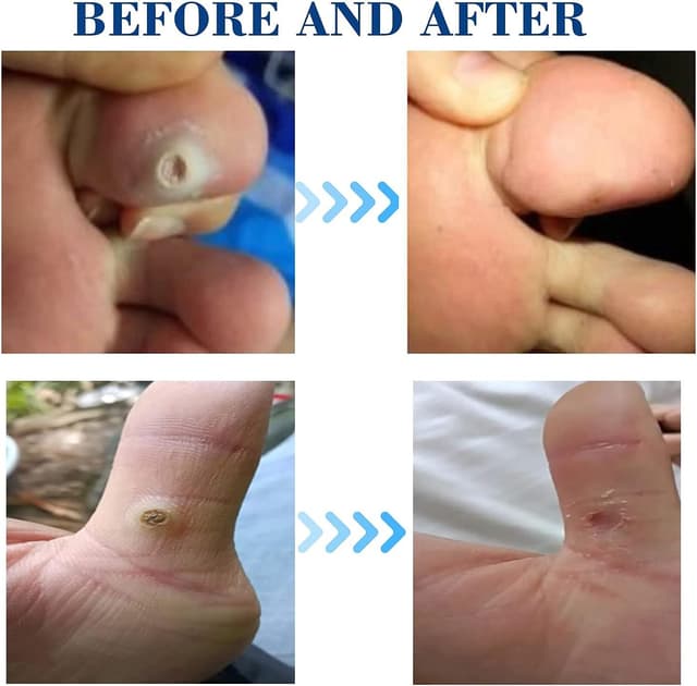 Thumbnail 3 de MQ Corn Remover Pads 24pcs