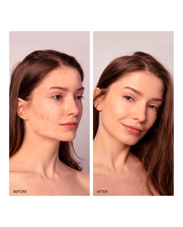 Thumbnail 3 de FOREO ESPADA™ 2 Plus dispositivo antiacné con luz LED 💆♀