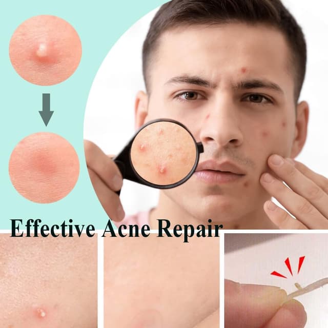 Thumbnail 3 de Zemolo 300 Parches para Granos Hidrocoloides