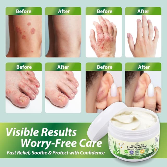 Detalle 1 de Teebaumöl Hautpilz Creme, 100 g