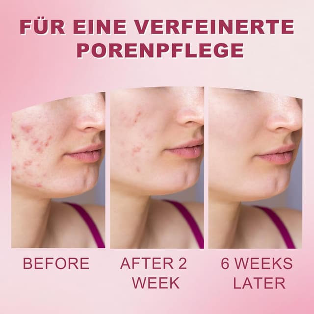 Detalle de Azelainsäure Creme 20 g mit 15 % Azelainsäure – für weniger Hautunreinheiten und ein gepflegtes Hautgefühl