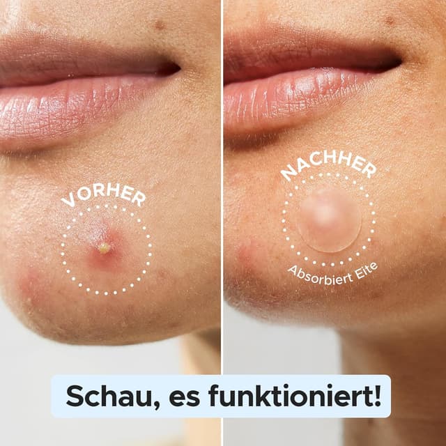 Detalle 2 de LitBear Pickel Patch 720 Stk 3 Größen