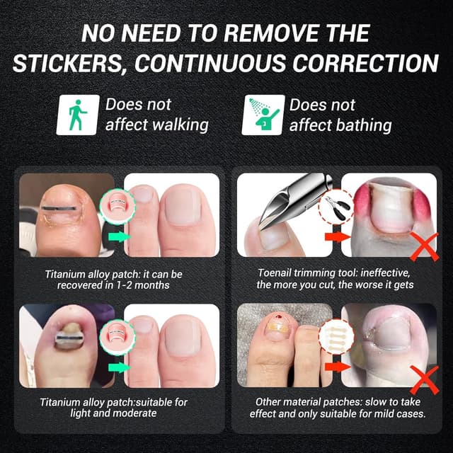 Detalle 2 de Reieset Ingrown Toenail Kit 0.59in