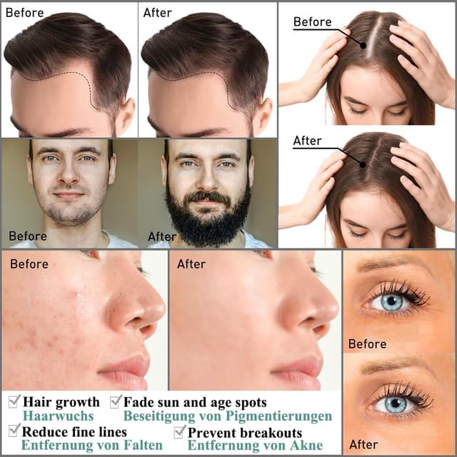 Detalle 2 de Zemolo 2er Derma-Roller Set (0,25 mm & 0,5 mm) mit 540 Micronadeln für Gesicht, Bart und Kopfhaut