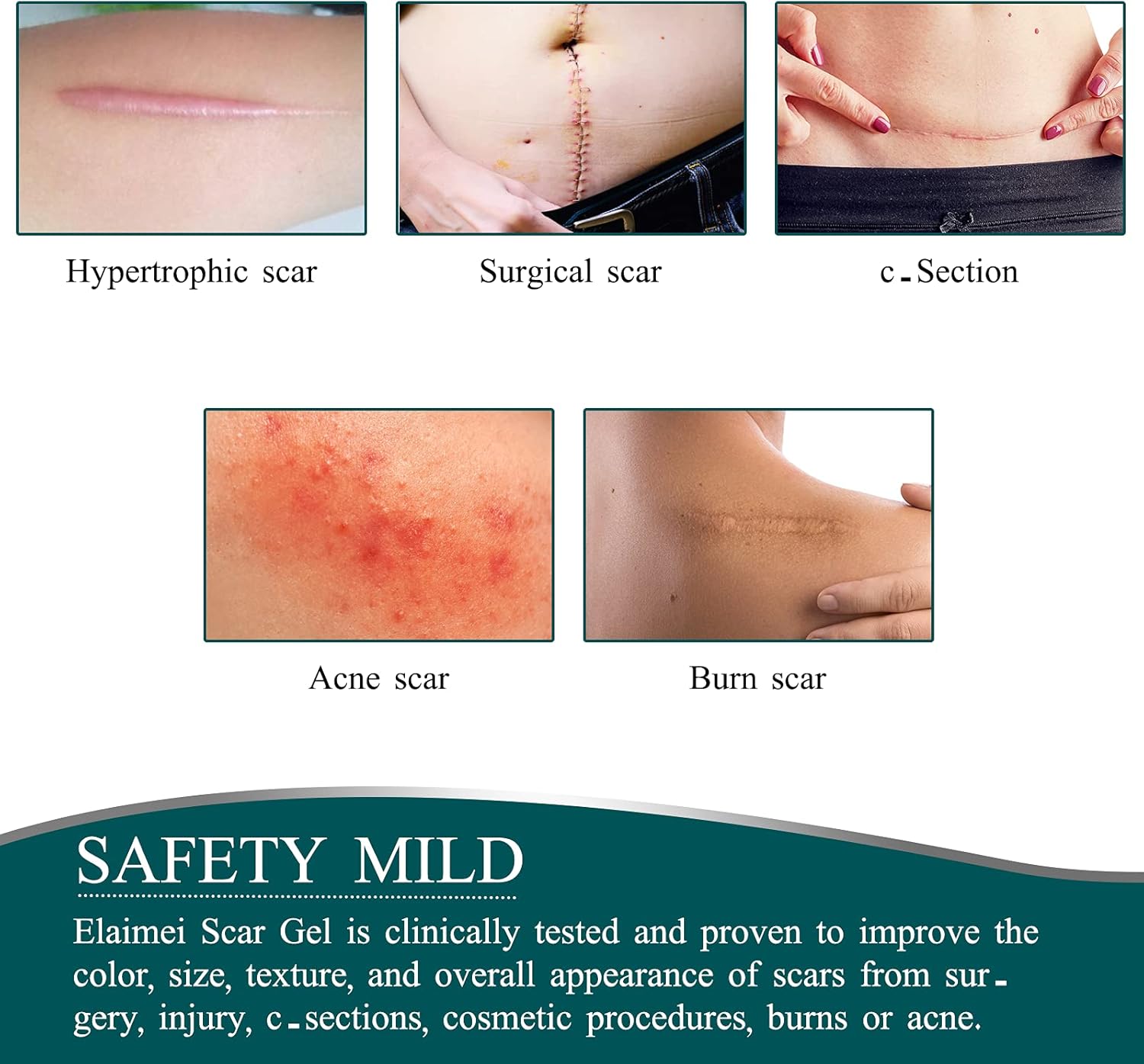 Thumbnail 2 de Silicone Scar Tape (1.6” x 120” – 3M): Reusable Self-Adhesive Scar Sheets for Old & New Scars