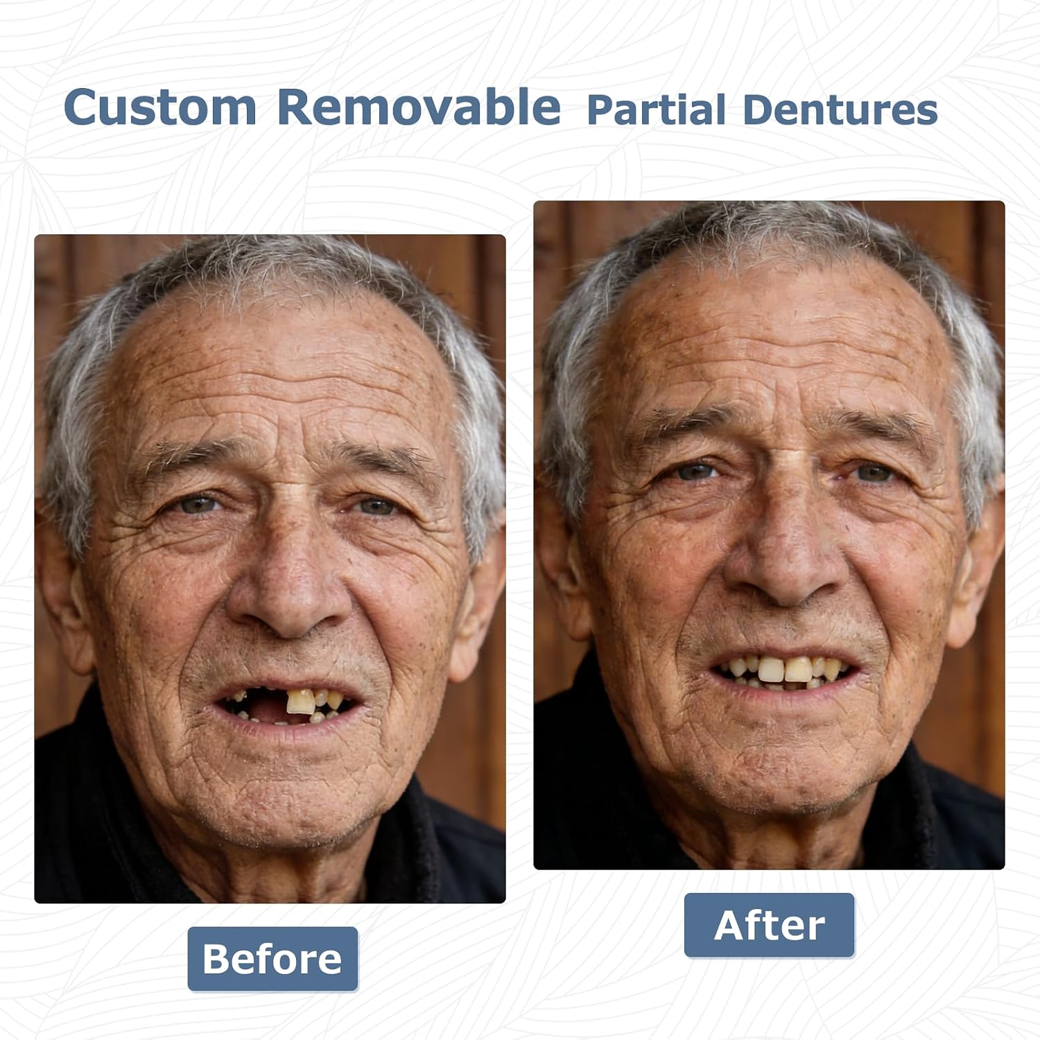 Detalle 2 de Iviiccov Custom 1-Tooth Partial Denture, Removable Flipper with Storage Case