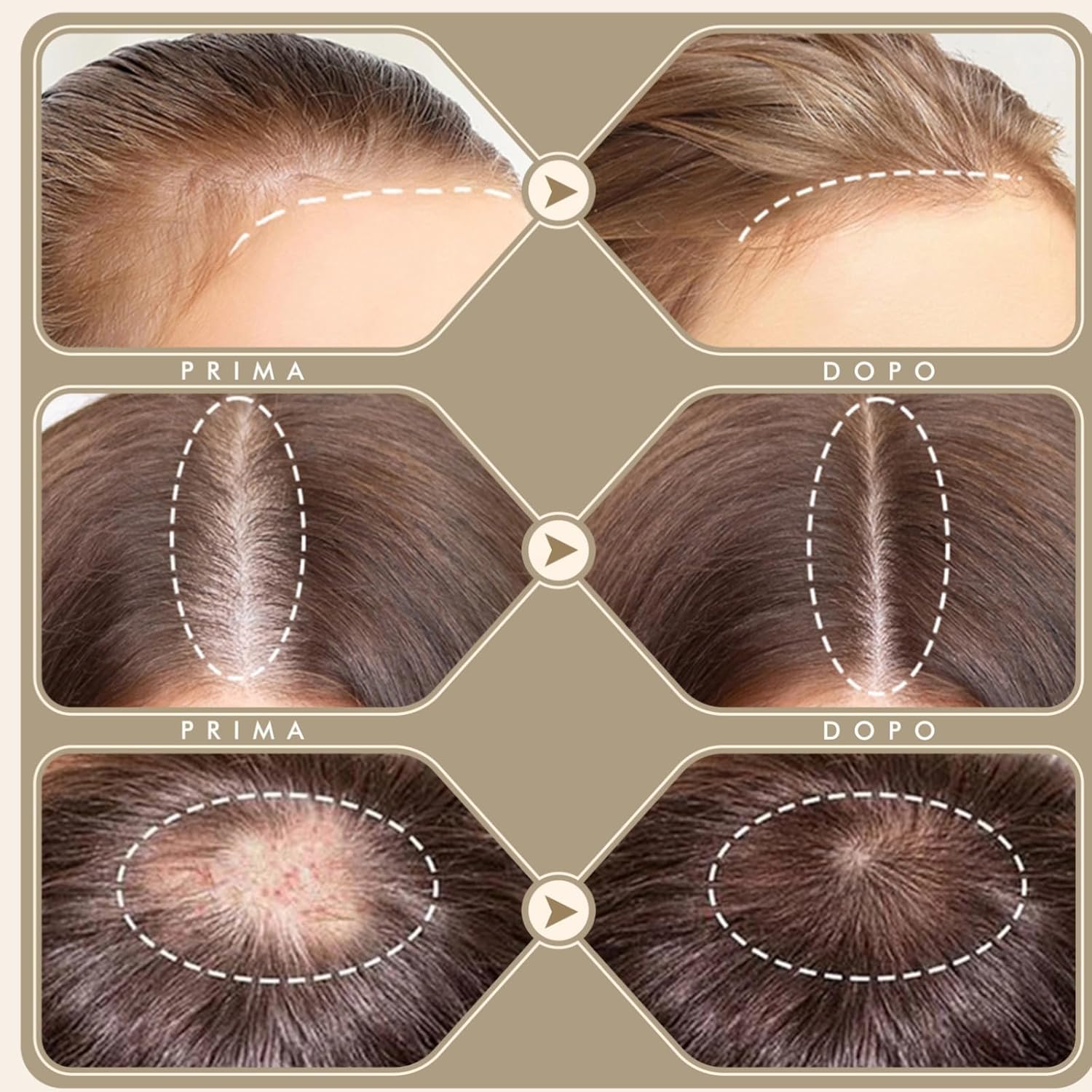 Detalle de Derma Stamp Regolabile 0-3 mm con 120 + 64 aghi in titanio – Crescita capelli, barba e viso