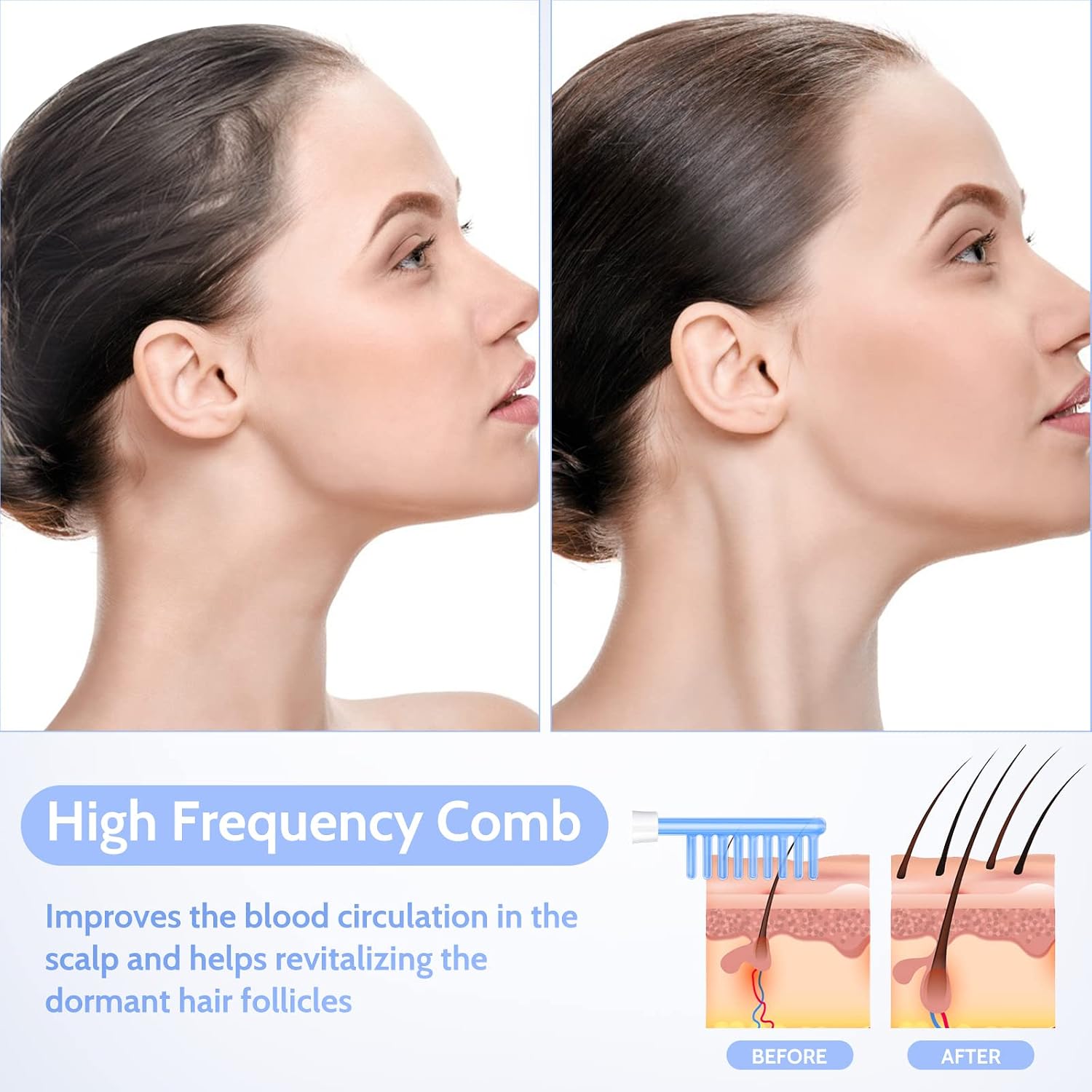 Detalle 2 de Yofuly Máquina Alta Frecuencia facial portátil