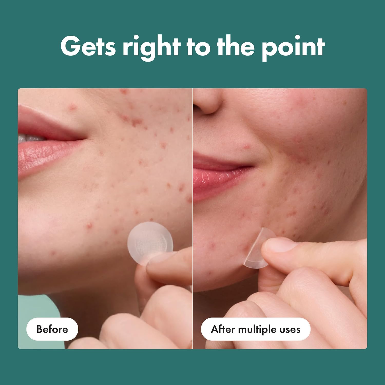 Detalle de Hero Cosmetics Mighty Patch Micropoint Acne Patches, 8 Count, 395 Micropoints