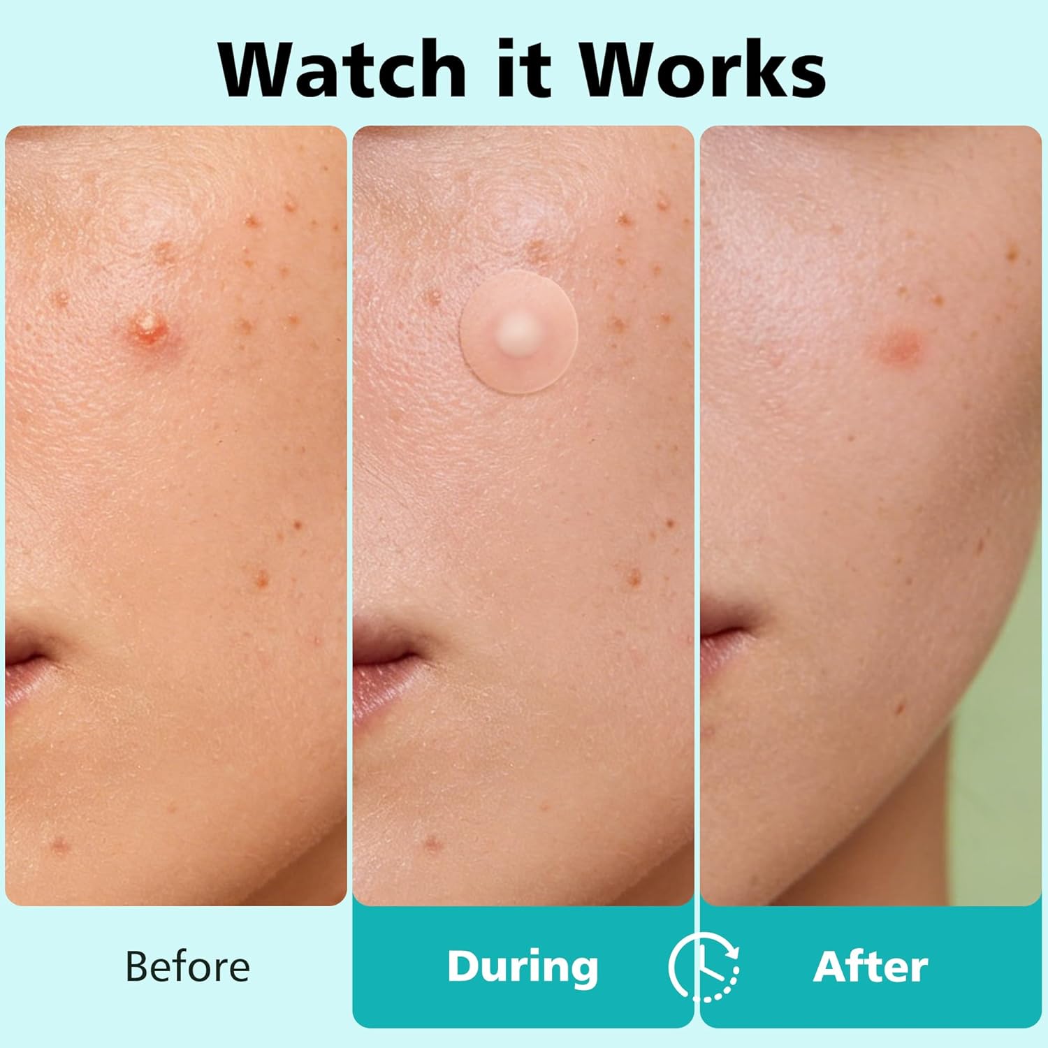 Thumbnail 2 de Dr.patch Pimple Patches for Face - 600 Count, 4 Size Hydrocolloid Acne Patches