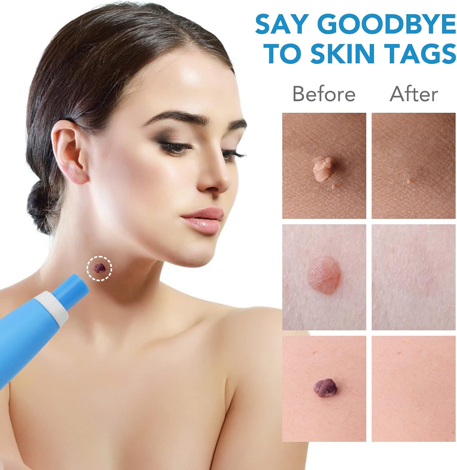 Detalle 2 de Skin Tag Removal Kit 40 bands 🩺