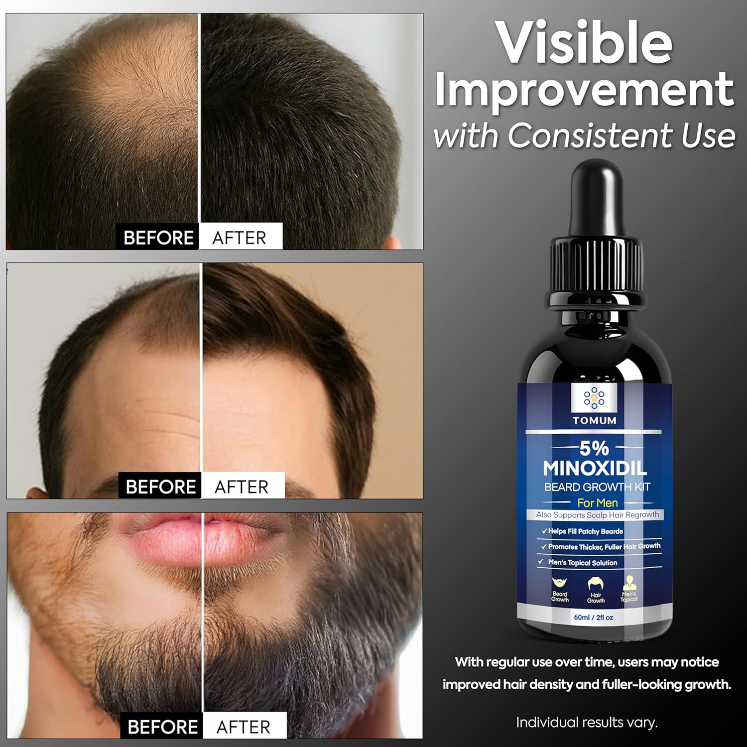 Thumbnail 2 de TOMUM 5% Minoxidil Beard Growth Kit for Men – Hair & Beard Regrowth Serum