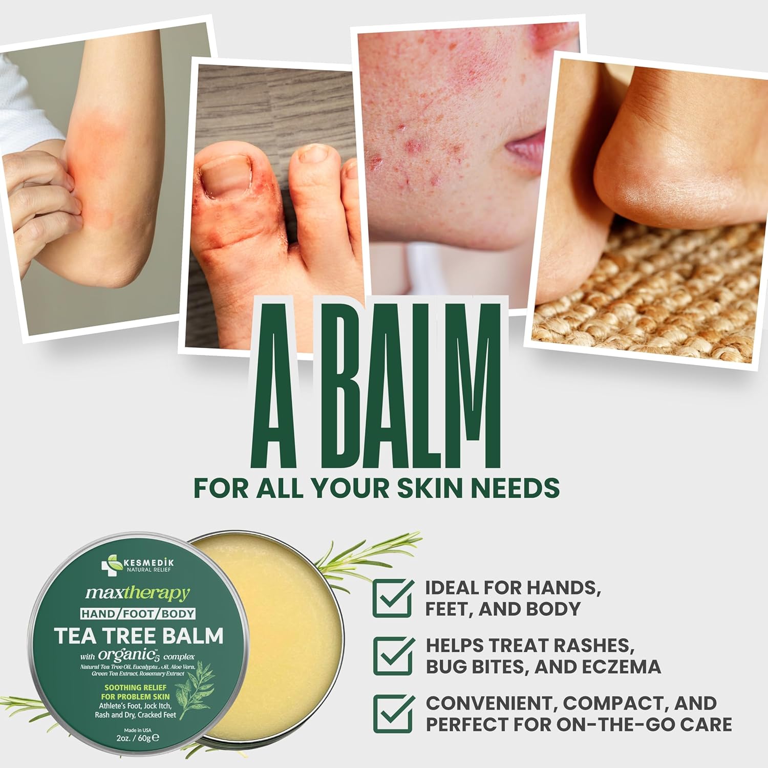 Detalle de KESMEDIK Tea Tree Oil Balm (2-Pack) for Itching, Rashes, Athlete’s Foot, Jock Itch & Dry Skin