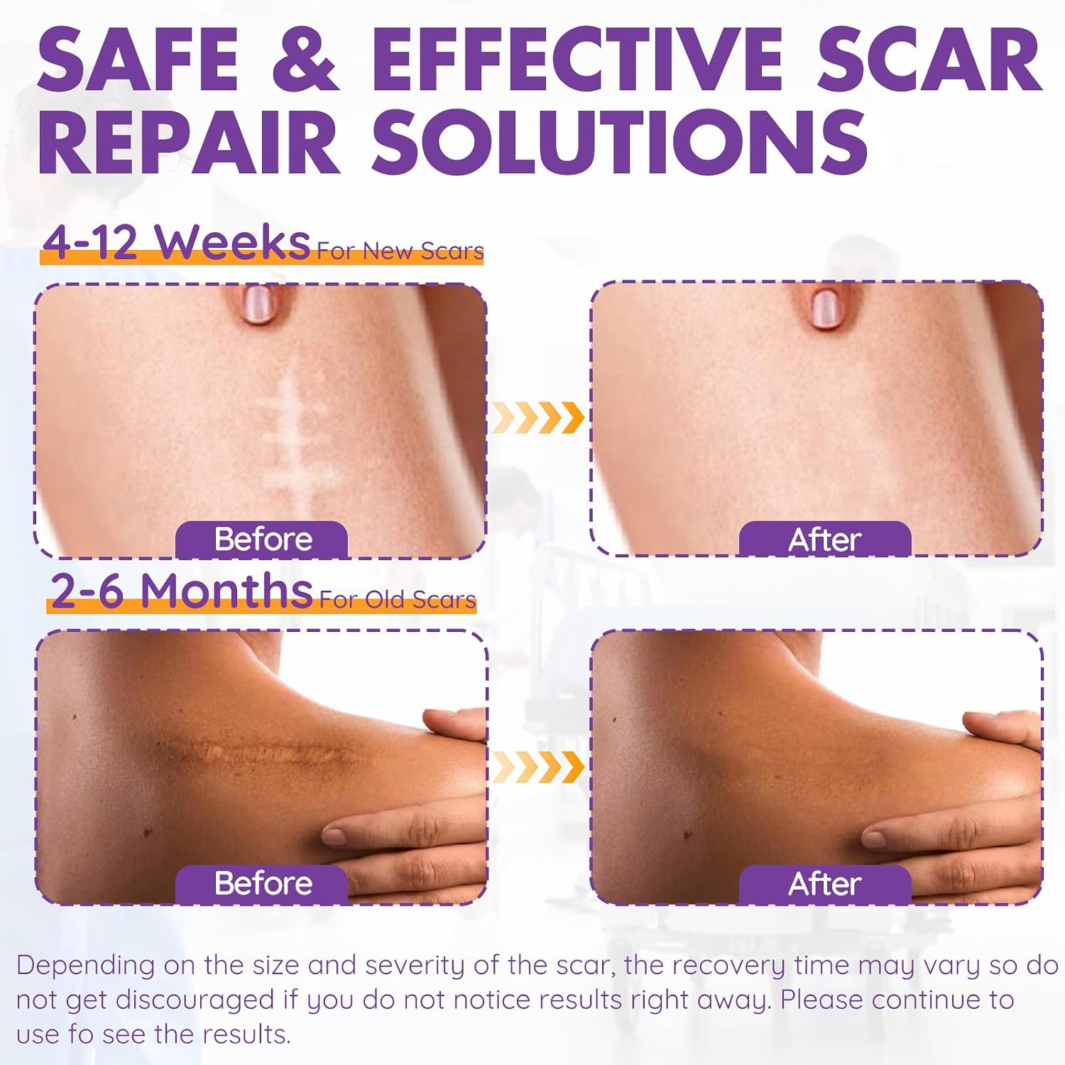 Thumbnail 4 de Silicone Scar Sheets 1.6" x 79" Roll