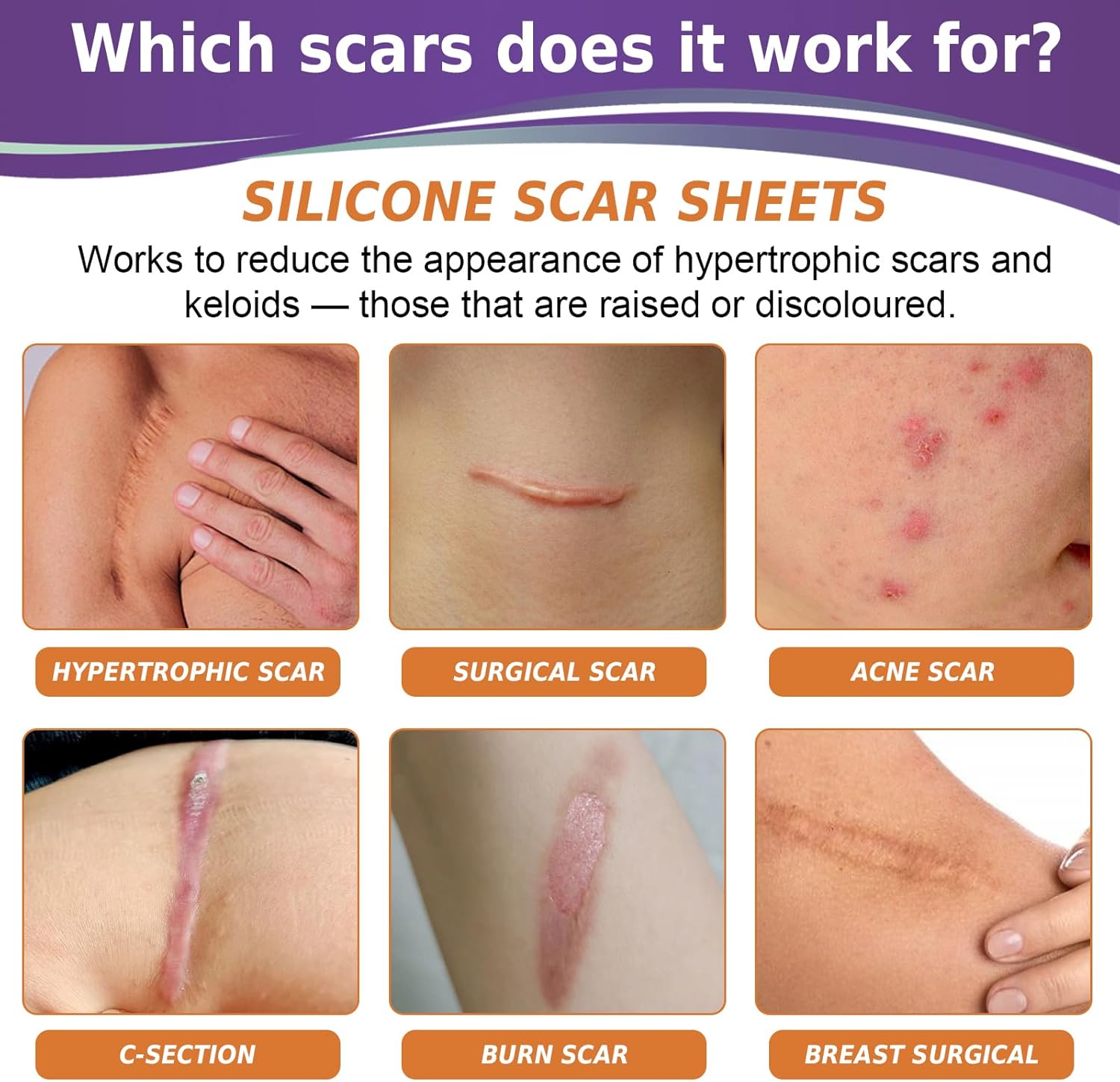 Thumbnail 1 de Psecici Medical-Grade Silicone Scar Tape review: 4cm x 3M for C-sections, tummy tucks and scars