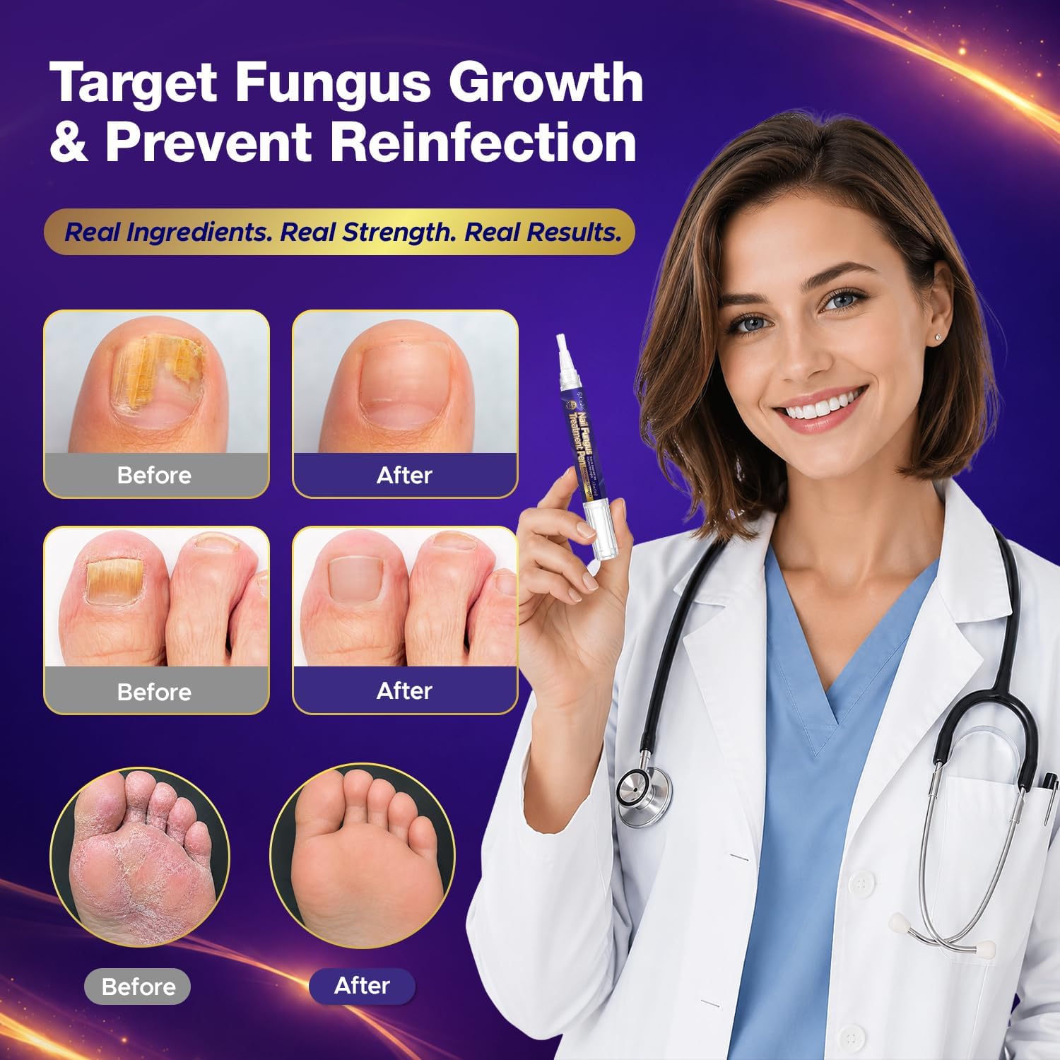 Thumbnail 1 de UAUKO Toenail Fungus Treatment Pen, 25% Undecylenic Acid, Pack of 4