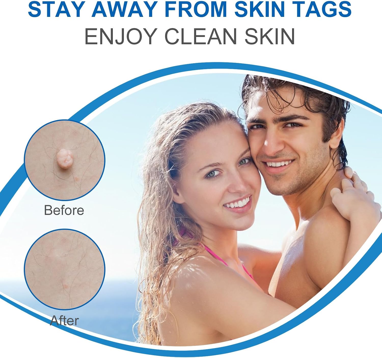Thumbnail 6 de Skin Tag Removal 2in1 New Upgrade Auto Skin Tag Removal Kit (1-9mm) – Painless Home Solution