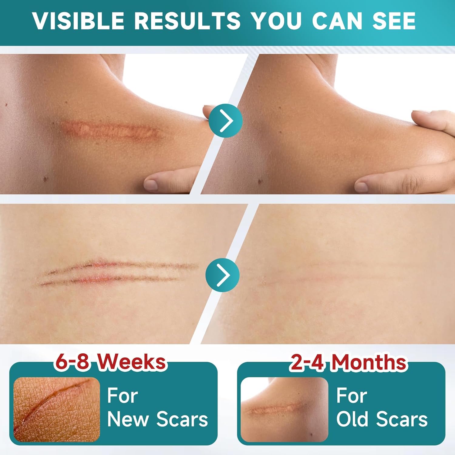 Detalle de Pumkot Silicone Scar Sheets: Medical-Grade Scar Tape for Surgical Scars, C-Sections, Burns