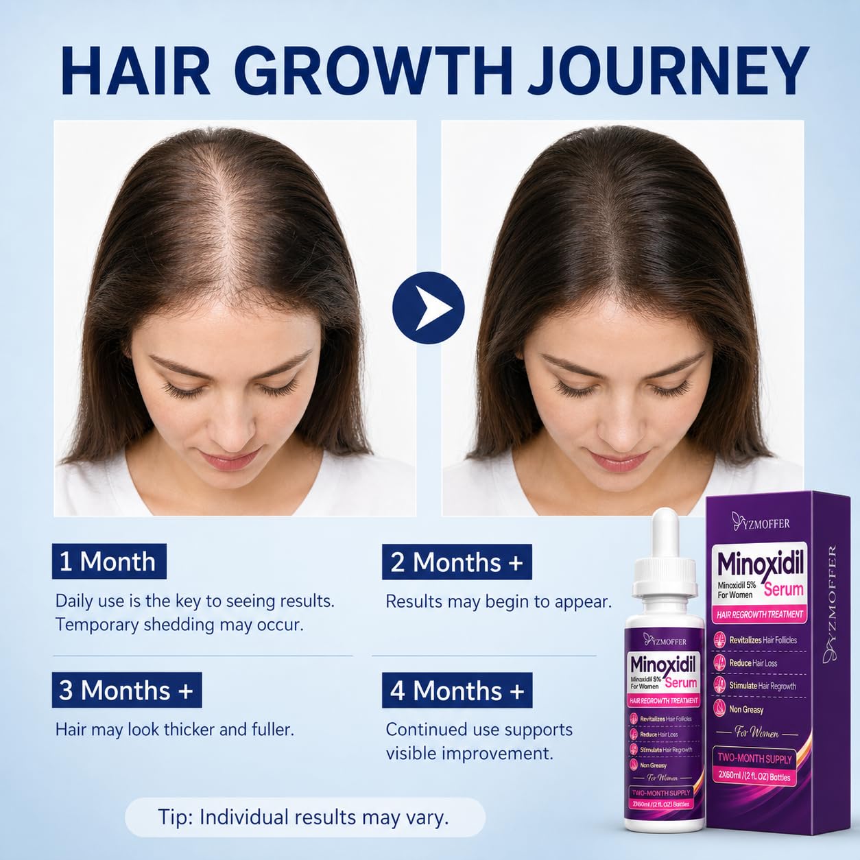 Detalle 2 de Yzmoffer 5% Minoxidil Hair Regrowth Treatment for Women, 2-Bottle Set
