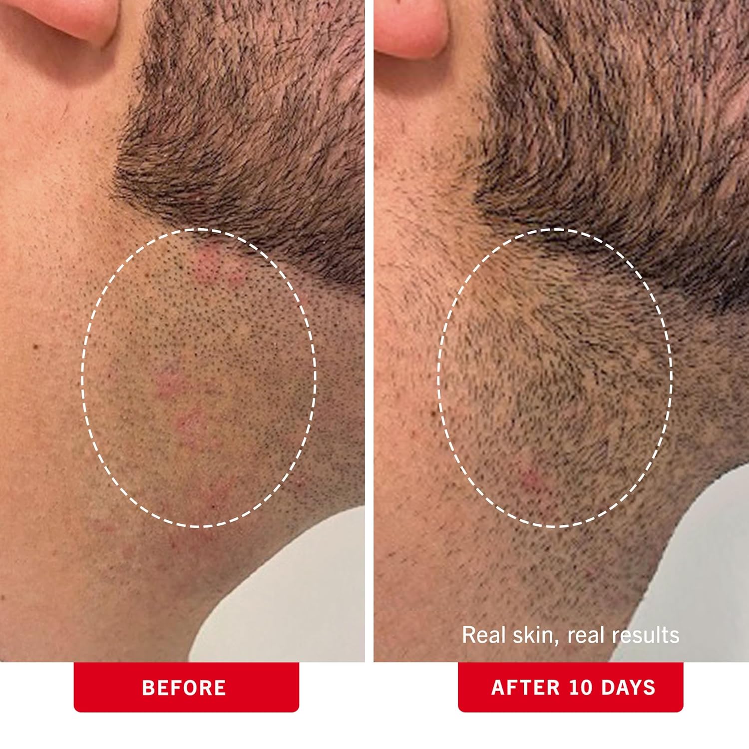 Thumbnail 3 de First Aid Beauty Ingrown Hair Pads with BHA + AHA (Glycolic & Salicylic) — Aftershave Treatment Pads for Men & Women, 60 Pads