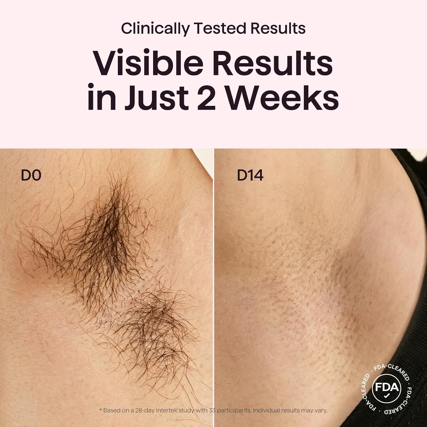 Thumbnail 2 de Wavytalk IPL Laser Hair Removal Device — Bare It with Precision Roller for Face, Body & Bikini