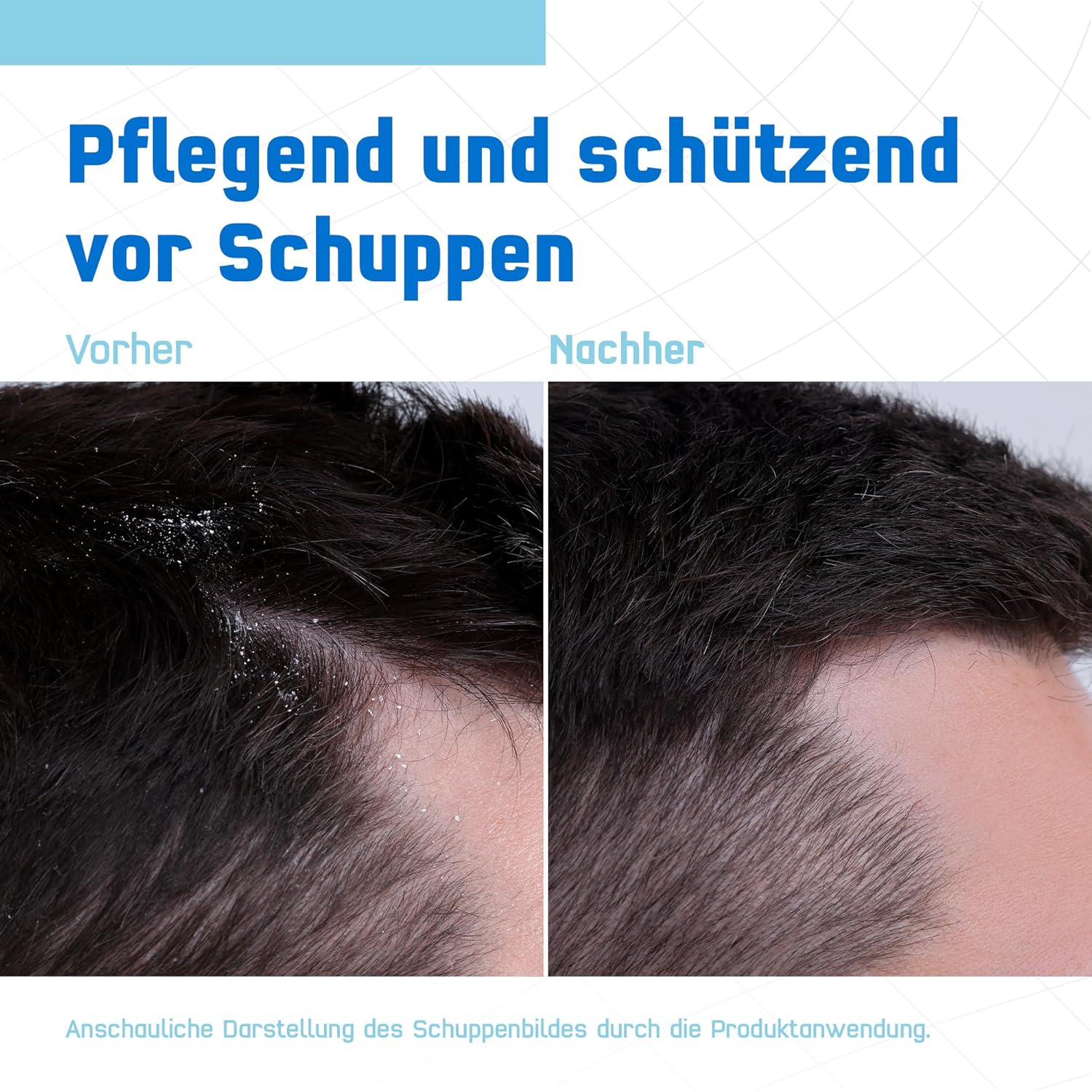 Thumbnail 3 de Terzolin Expert Schuppen-Shampoo für trockene Kopfhaut bei Juckreiz & Schuppen (200 ml)