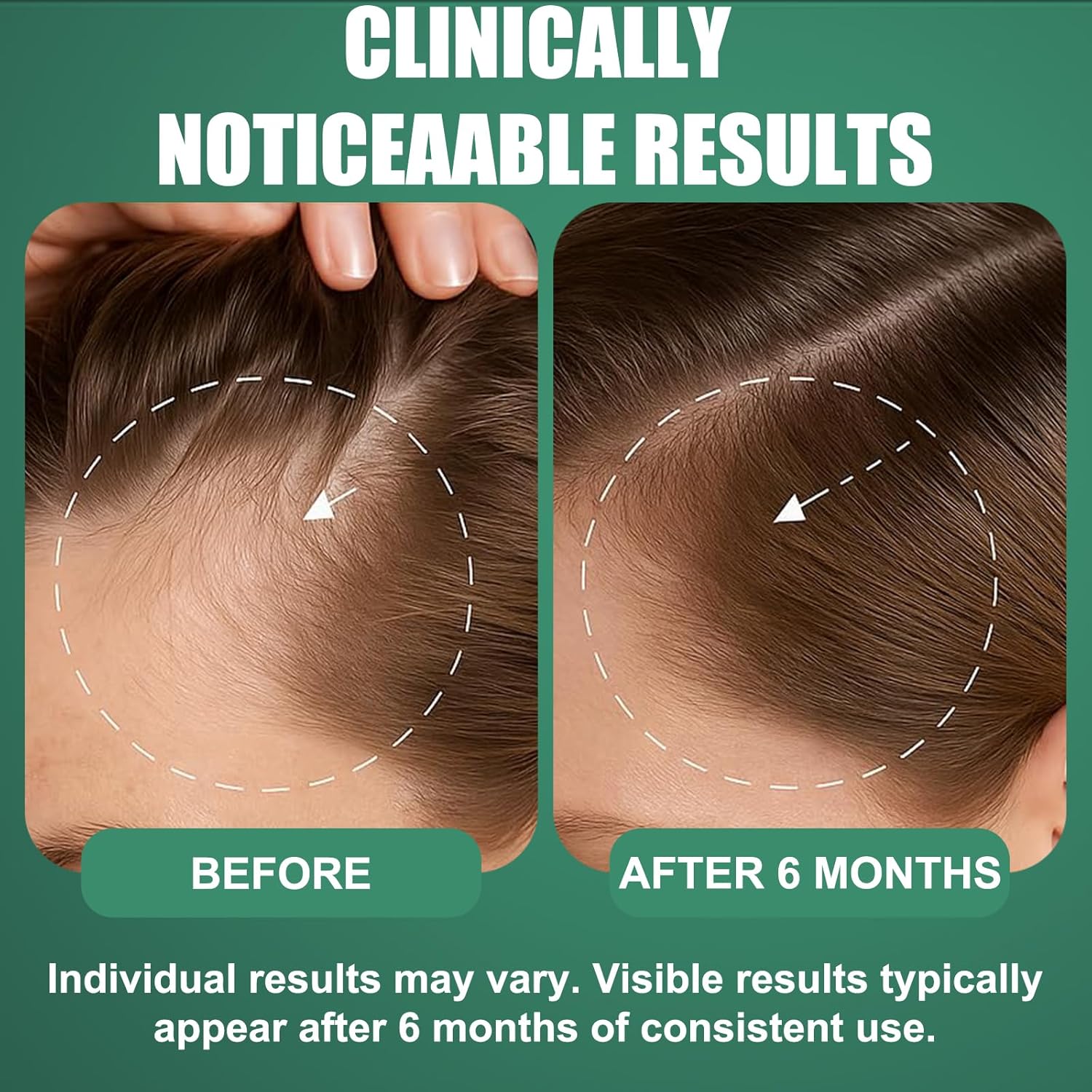 Detalle de OURMUST 5% Minoxidil Hair Regrowth Spray, 2 Bottles with Biotin & Rosemary