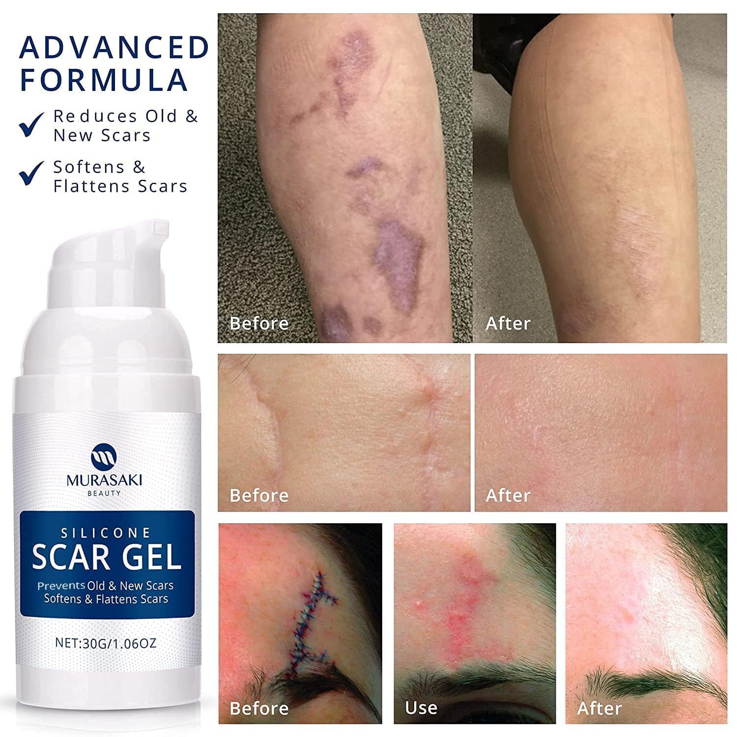 Detalle de 100% Silicone Scar Gel 2-Pack (2 x 1.06oz) for Surgical Scars, C-Section, Acne Marks, Keloids, Burns & Stretch Marks