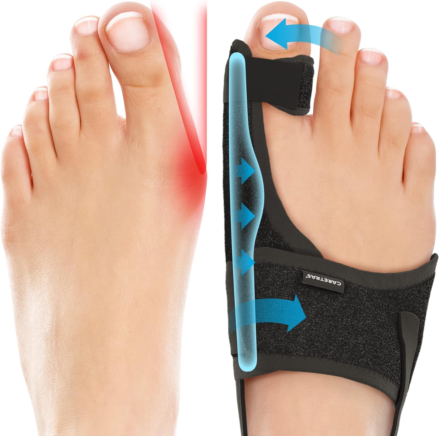 Detalle de Caretras 2-Pack Bunion Corrector: Adjustable Day/Night Orthopedic Toe Support