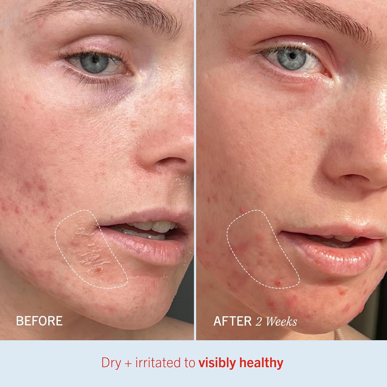 Thumbnail 5 de First Aid Beauty Ultra Repair Cream – Whipped Face & Body Moisturizer with Colloidal Oatmeal