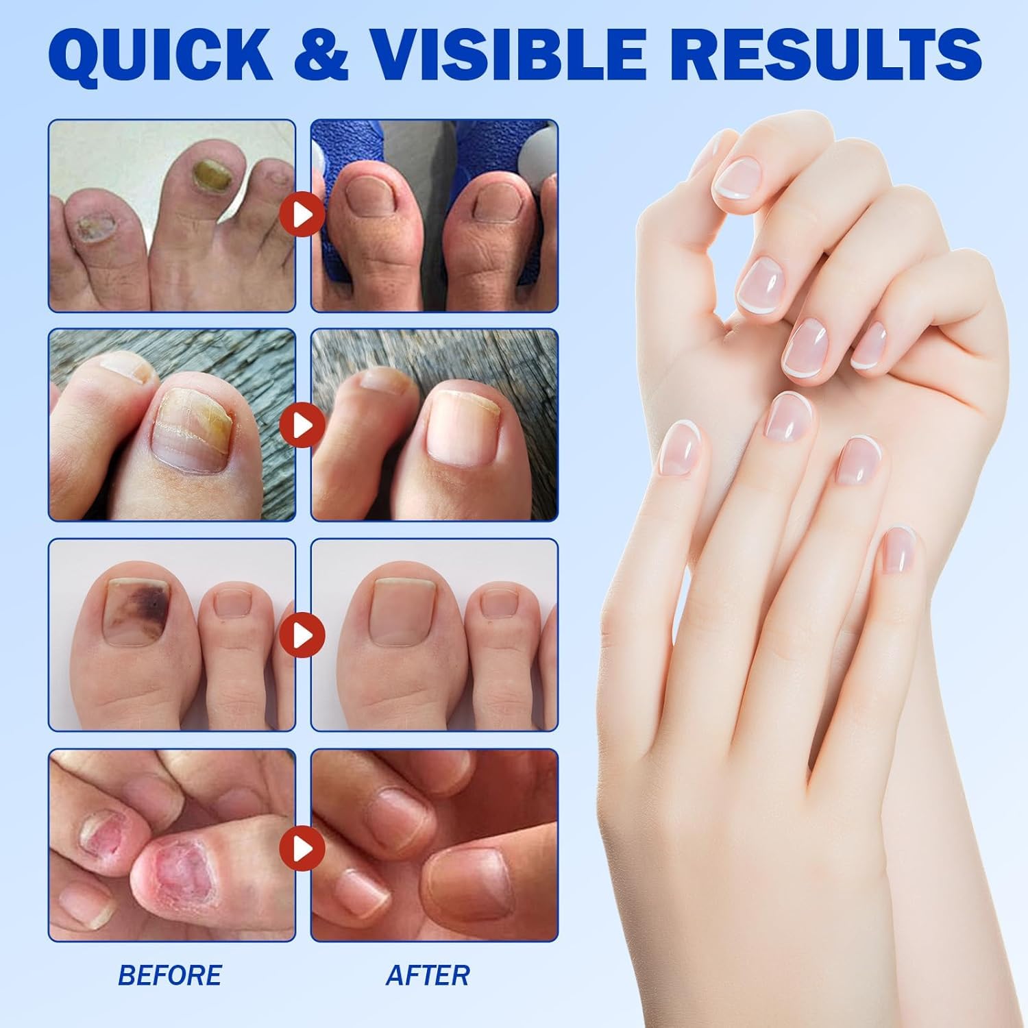 Detalle 2 de Nail Patches Toenail Treatment 42-Count