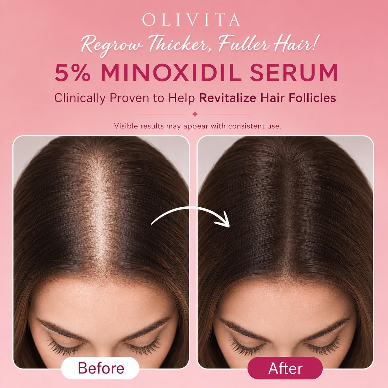 Thumbnail 4 de OLIVITA Minoxidil Hair Regrowth Serum 5%