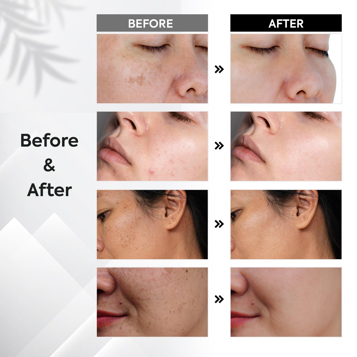 Detalle de Pigmentflecken Entferner Gesicht Anti Pigment Dark Spot Correcting Glow Serum mit Niacinamid & Vitamin C