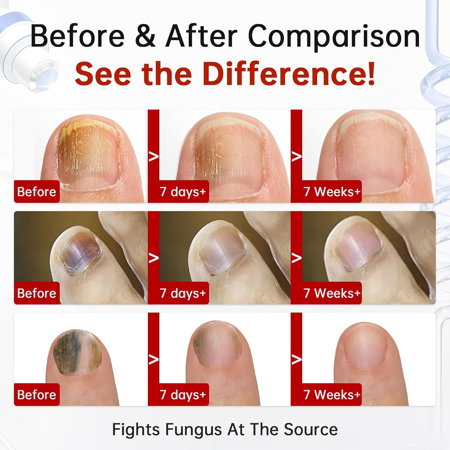 Thumbnail 2 de Toenail Fungus Treatment with 1% Tolnaftate