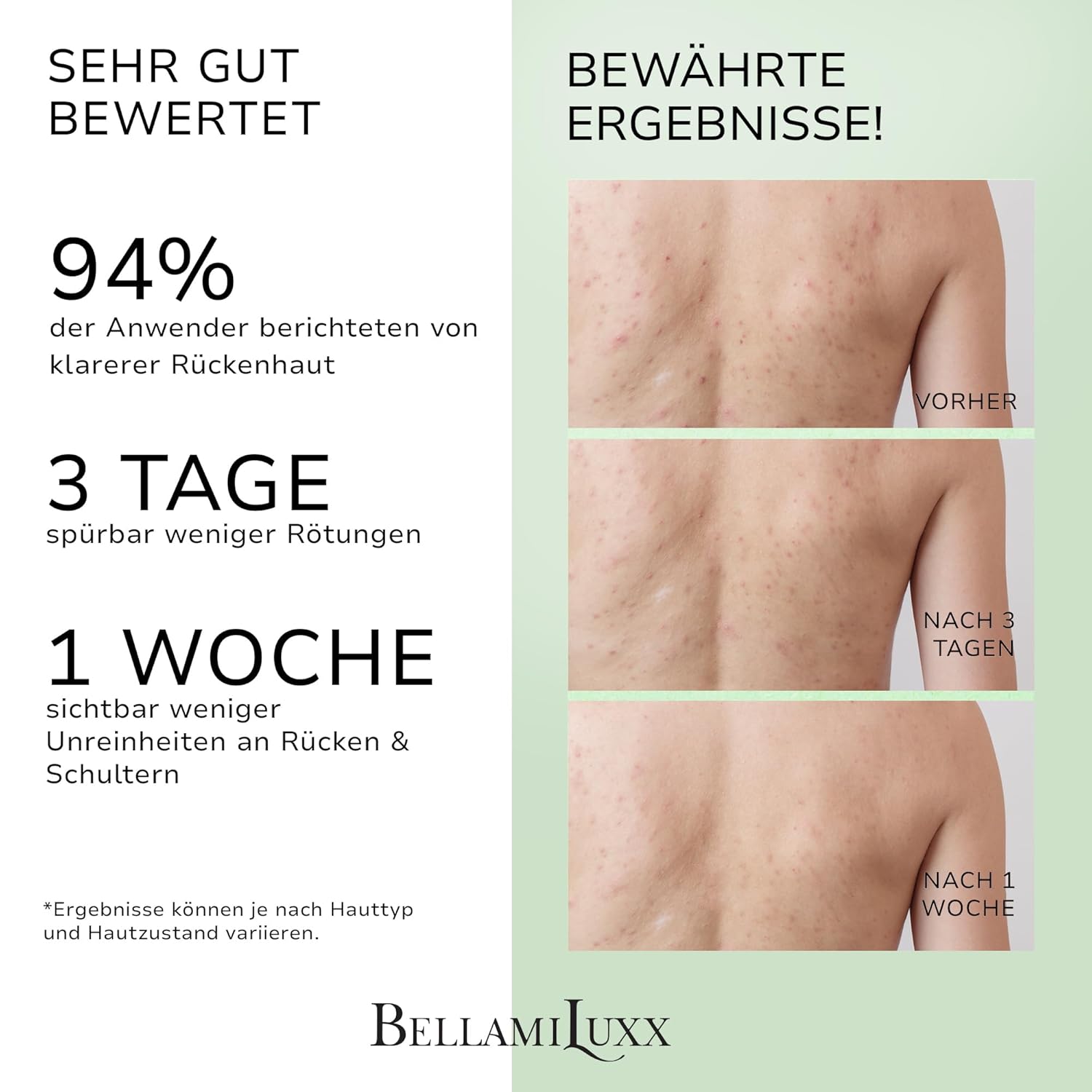 Thumbnail 1 de BellamiLuxx Rücken- & Körper Akne Spray mit 2% Salicylsäure & Teebaumöl – Aknespray für Rücken, Brust & Schultern