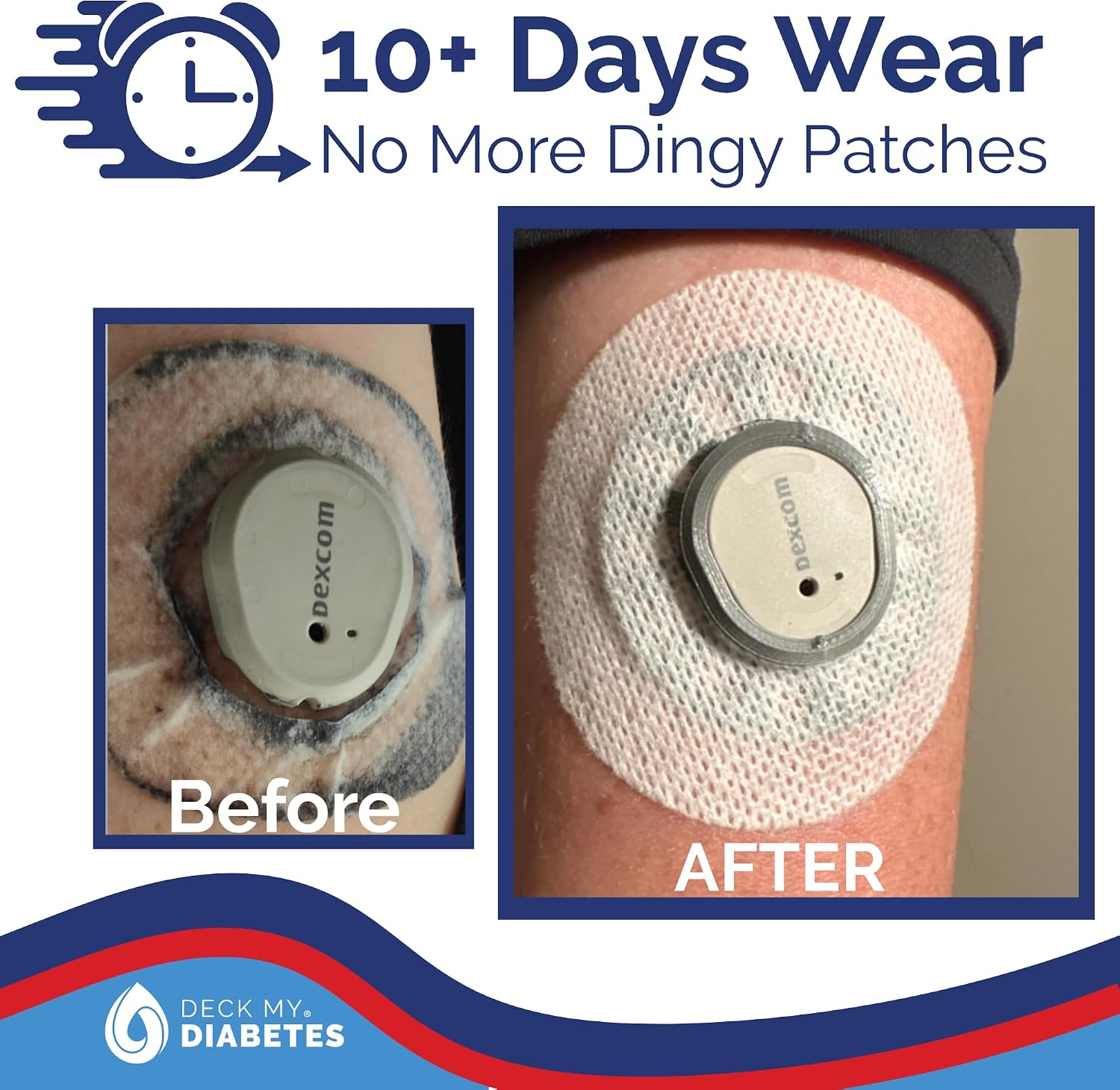 Detalle de Deck My Diabetes Dexcom G7 GripShield センサー保護カバー 柔軟TPU・再利用可能・クリスタルクリア