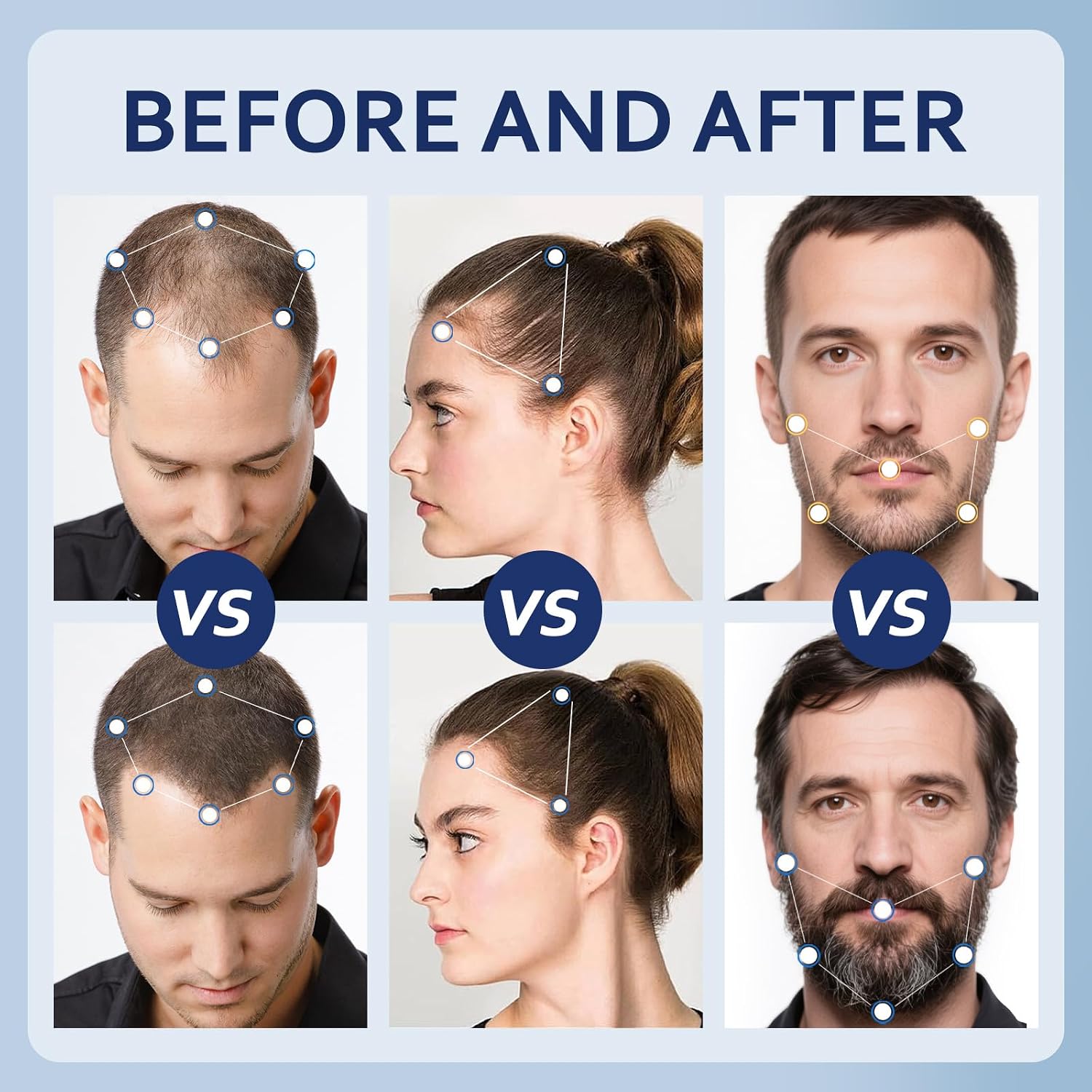 Thumbnail 3 de Minoxidil for Men & Women Liquid Solution (5%), 4 FL OZ + 2 Droppers