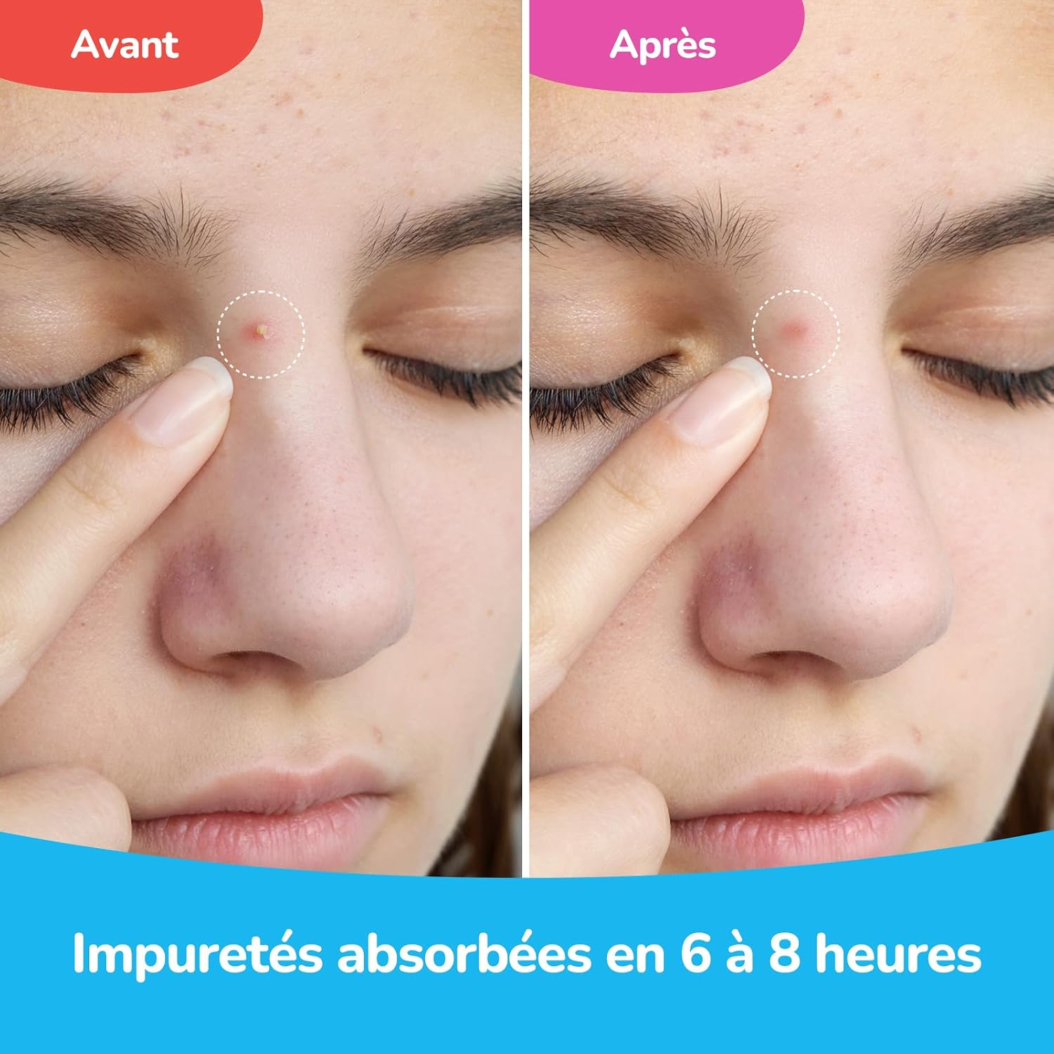Detalle de Patch Bouton Invisible Nuit & Jour – Soin Visage Hydrocolloïde avec Acide Salicylique (72 Patchs)