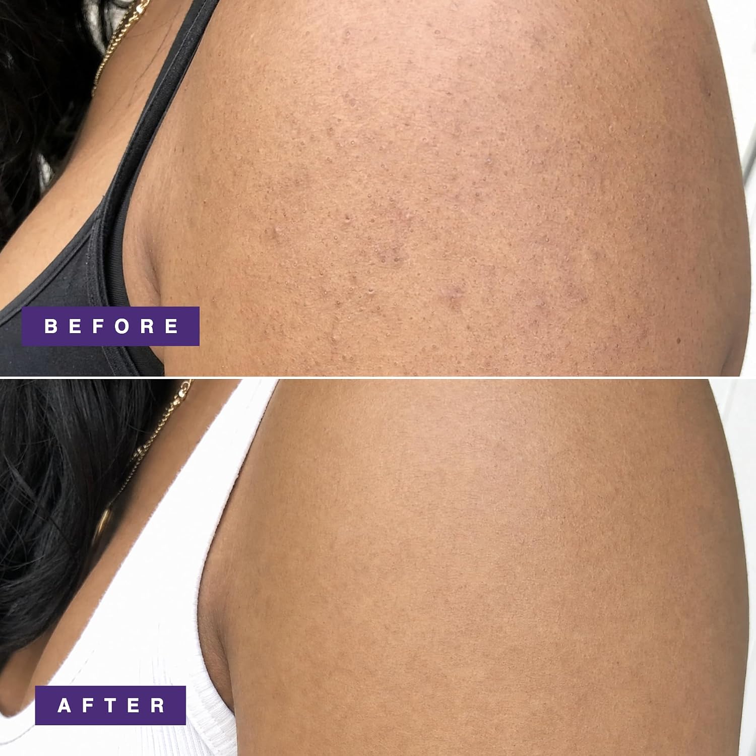 Detalle de DERMAdoctor KP Bump Eraser Body Scrub (10% AHAs + PHAs) for Keratosis Pilaris, Glycolic & Lactic Exfoliation, 8 fl oz